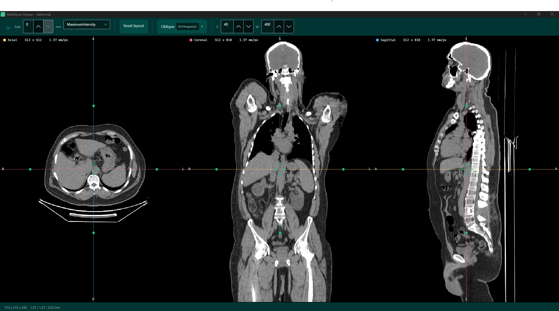 The MedVerse reformat window: axial, coronal and sagittal planes of a CT reconstructed at 1.37 mm per pixel, with linked crosshairs, draggable rotation handles for oblique angles, a maximum-intensity slab control and window centre and width of 40 and 400.