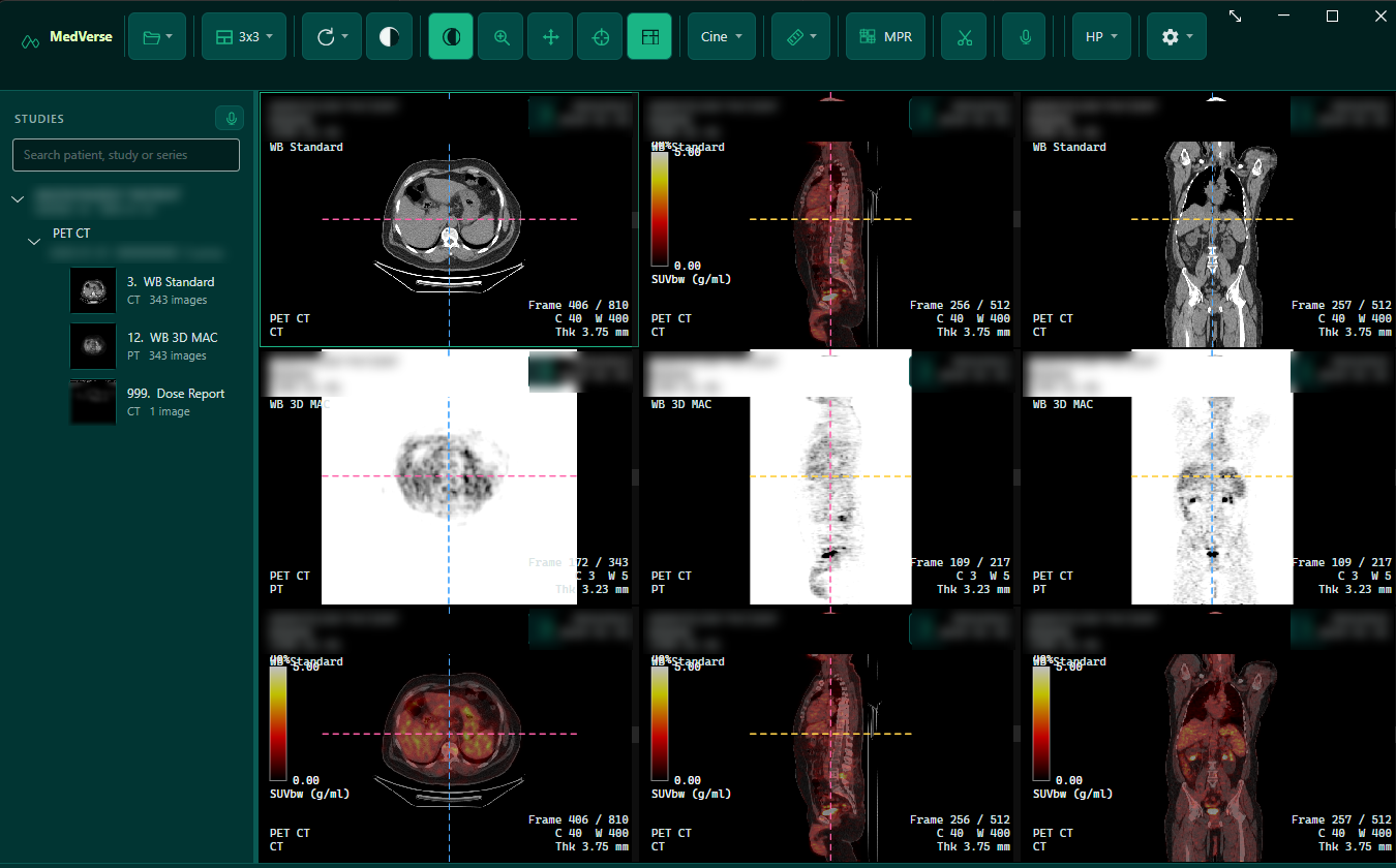 MedVerse ViewRAI showing a whole-body PET/CT in a three-by-three layout: CT, PET and fused series in axial, sagittal and coronal planes, with linked cursors, SUV colour bars and the study list on the left. The patient banner in each viewport is blurred out.